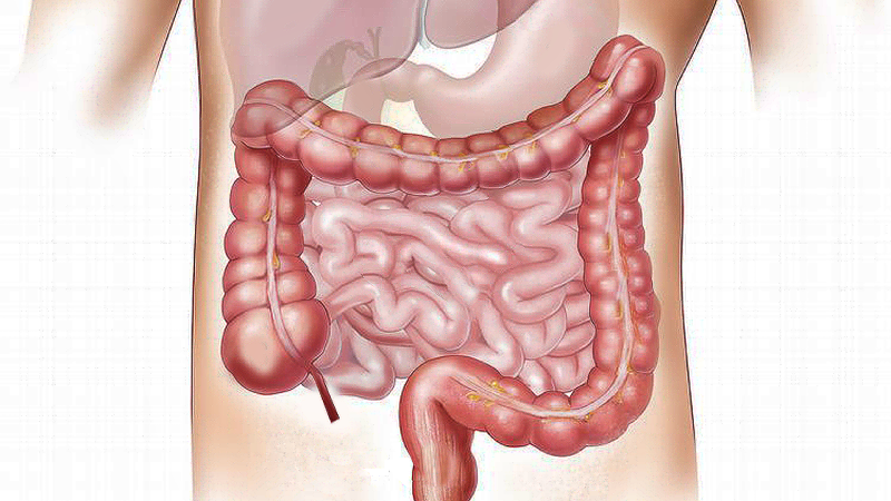 Dieta per Aderenze Intestinali