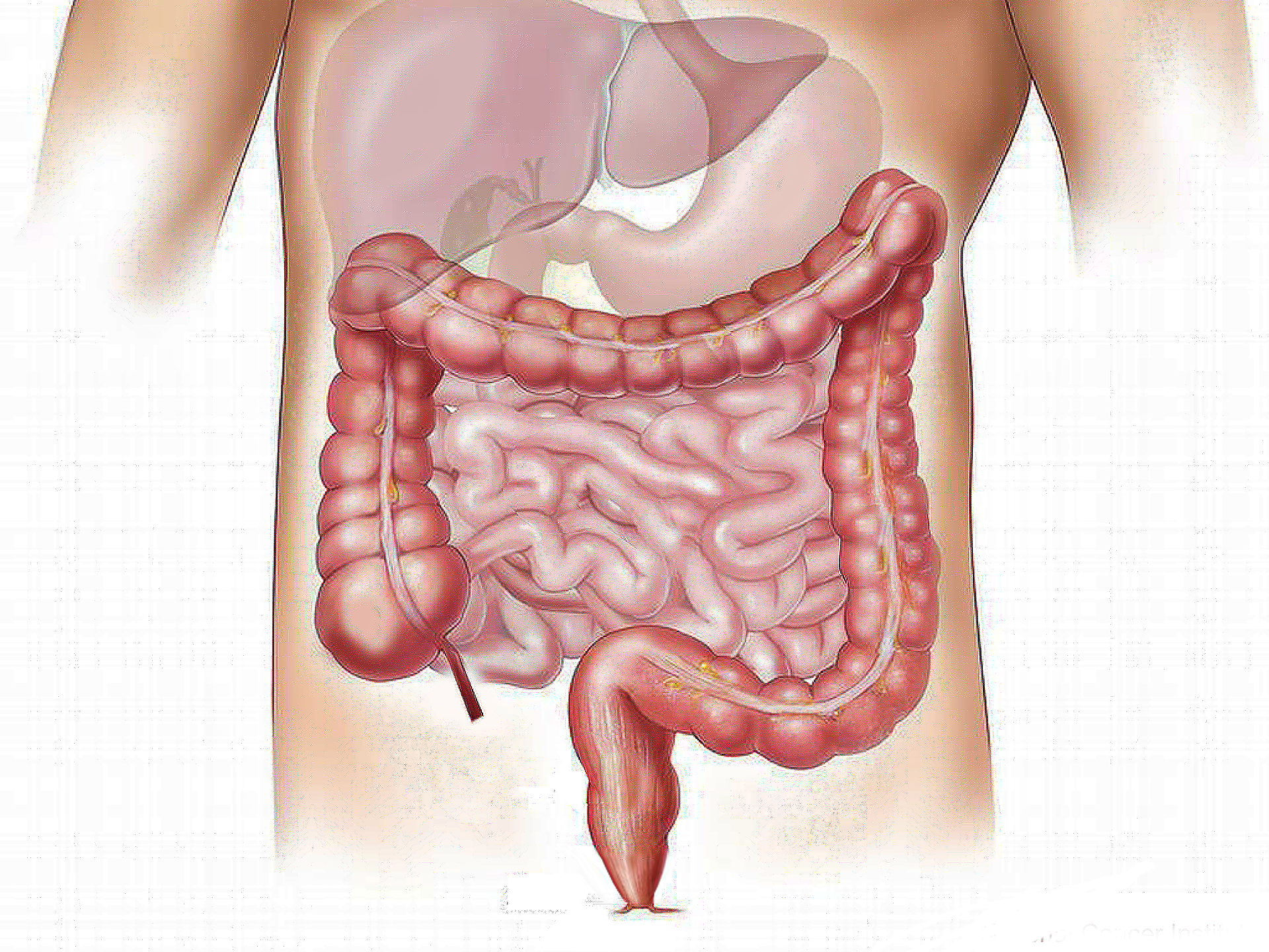 Dieta per Aderenze Intestinali
