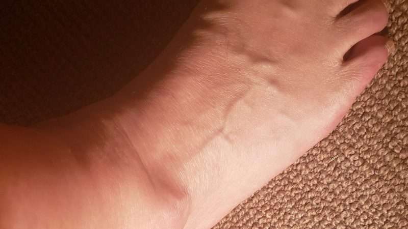 Perchè si Gonfiano le Gambe? Cause e Rimedi
