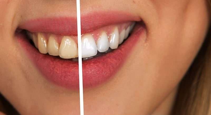 I luoghi comuni sull’odontoiatria e sugli interventi ai denti