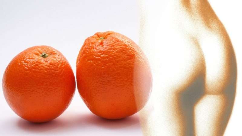 Pannicolopatia Edemato Fibrosa ovvero la “Cellulite”